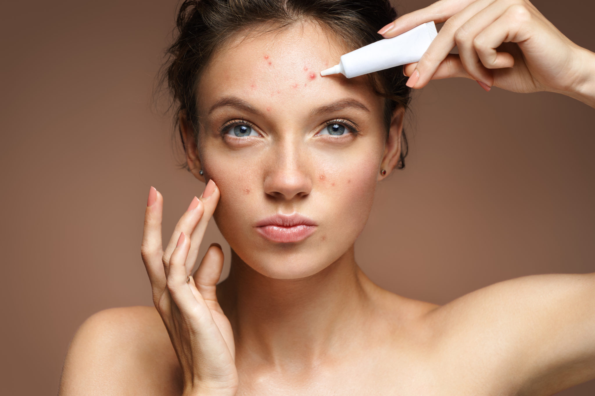 A lady with acne prone skin.