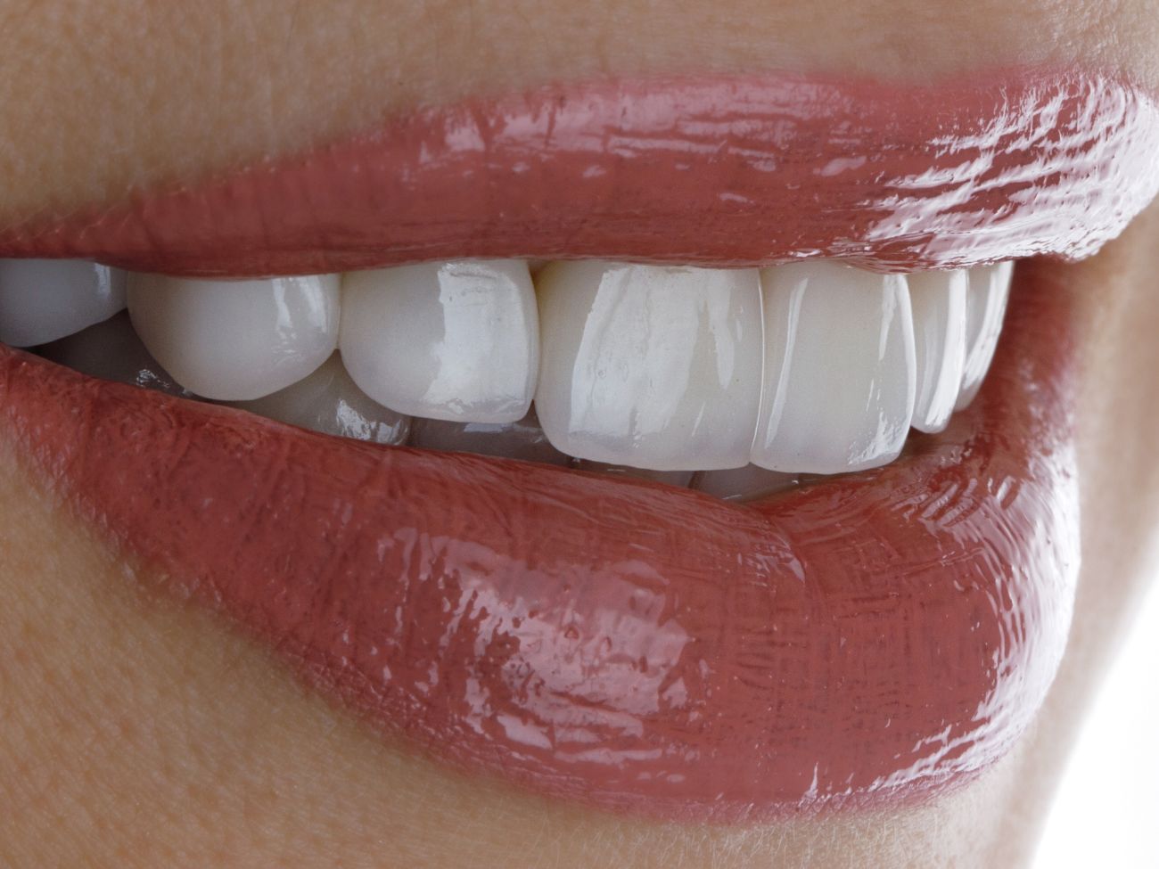 Veneers 1