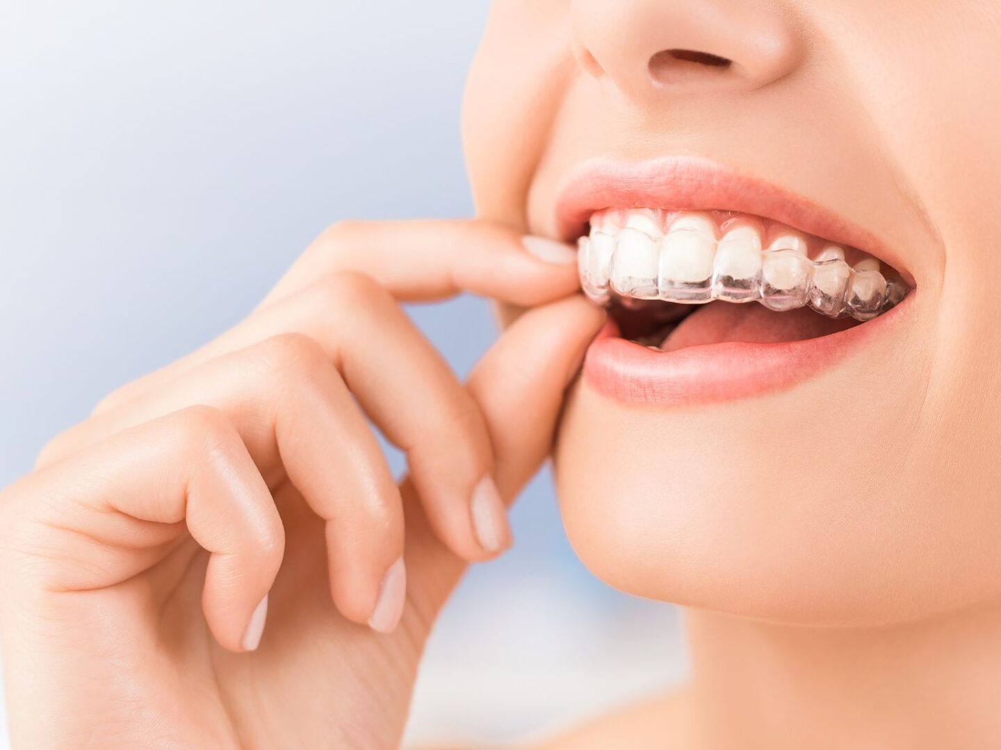 Lady wearing Invisalign aligners